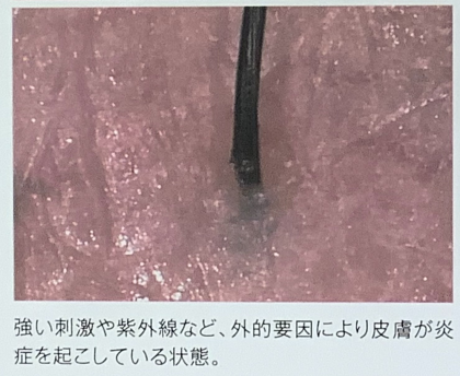 あなたの頭皮は大丈夫？
